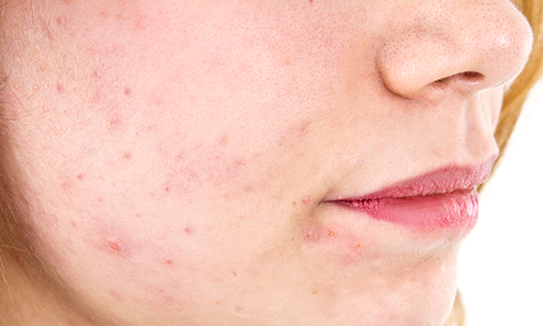 L’acné inflammatoire