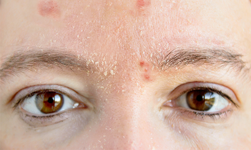 Effets secondaires des traitements contre l'acné 