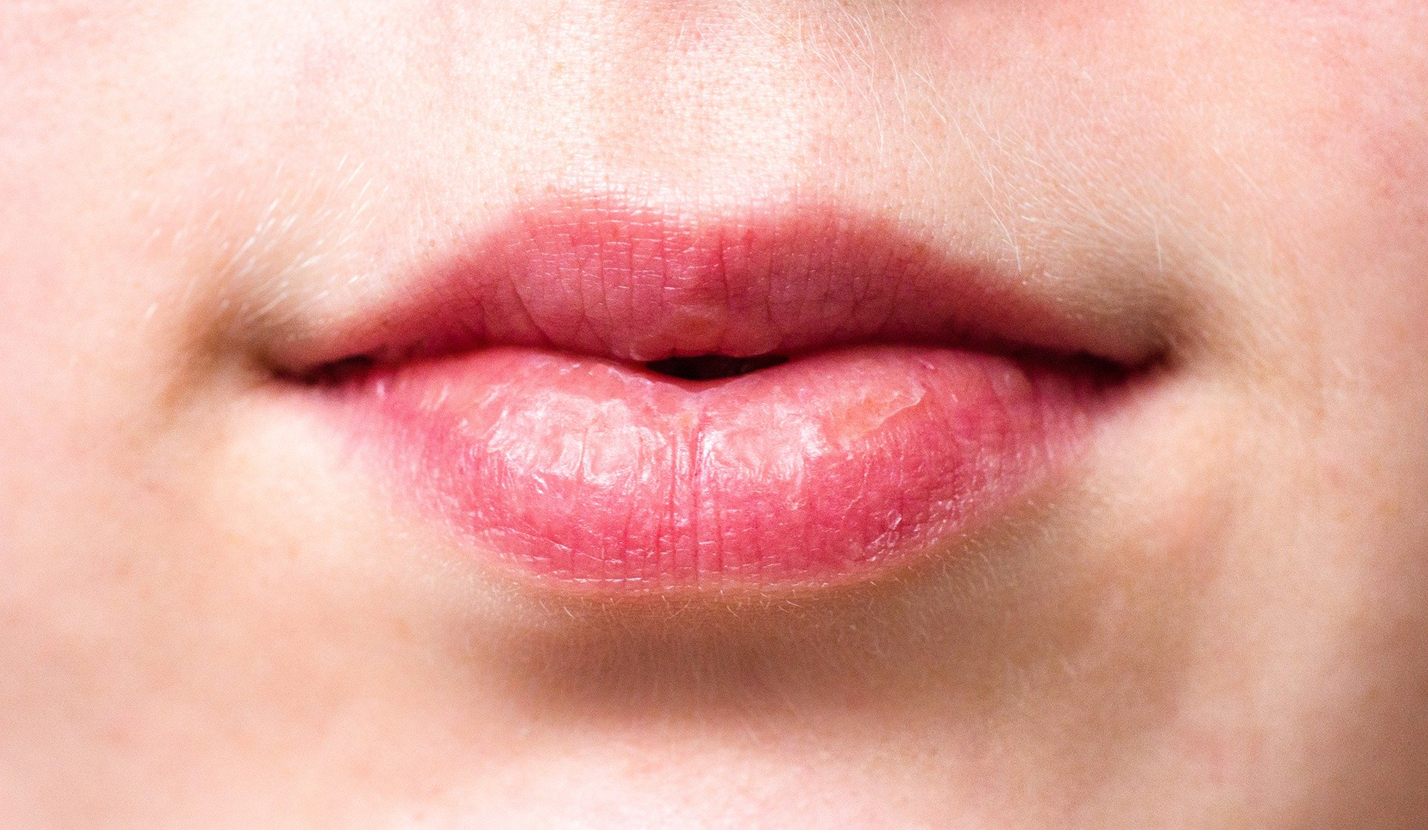 Stevig Traditioneel Punt Bescherm je gesprongen lippen met de juiste zorg | BIODERMA