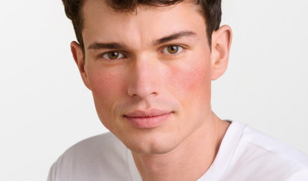 rosacée homme