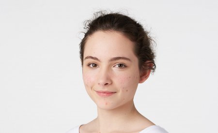 Bioderma - adolescent with acne-prone