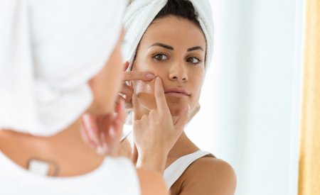 Seborroische dermatitis Seborroische dermatitis
