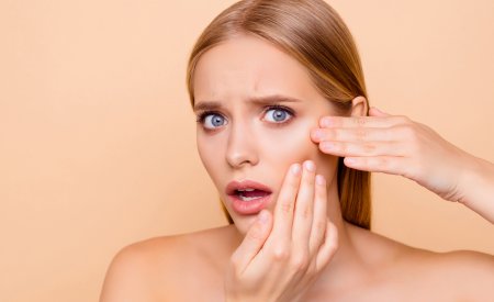 Bioderma - Woman with acne