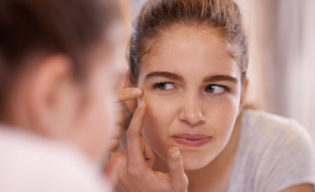 Bioderma - Adolescent with acne Bioderma - Adolescent with acne