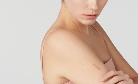 Peau atopique Peau atopique