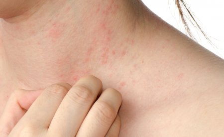 Eczema on the neck