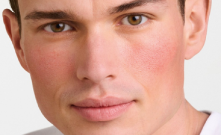 rosacée homme