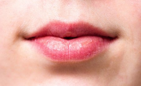 gesprongen lippen