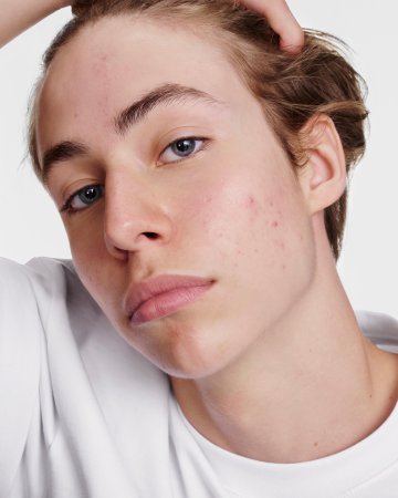 jeune acné 
