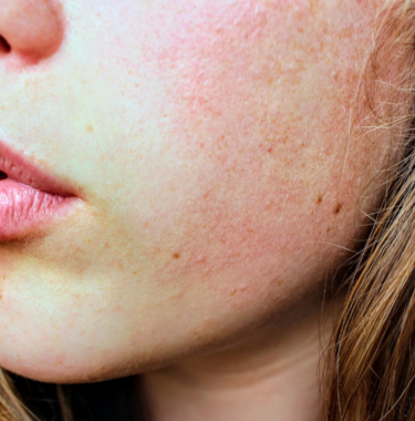 allergie cutanée