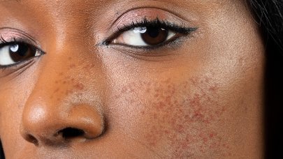 ROSACEE peau noire