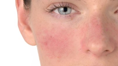 rosacée contagieuse