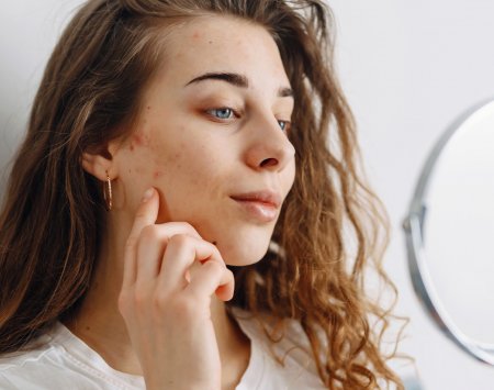 Woman indicating acne marks on her cheek, utilizing Sébium serum.​