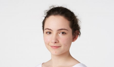 Bioderma - adolescent with acne-prone