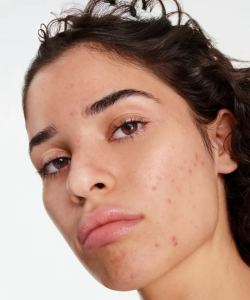 Femme acné
