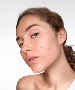 Femme avec de l'acné